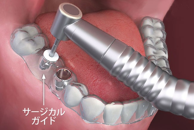 サージカルステント 画像2